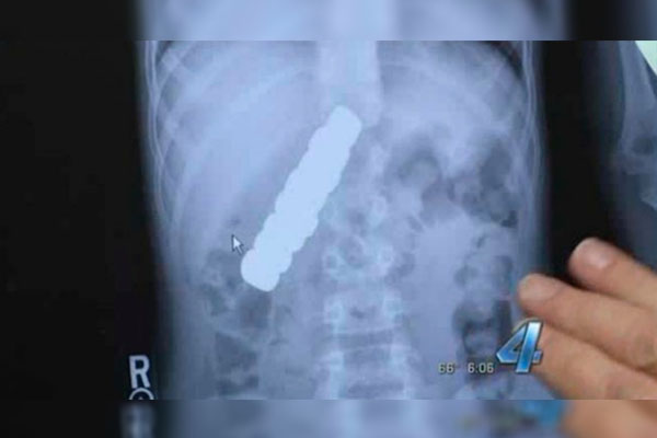 Le dolía el estómago: radiografía reveló que había tragado 8 imanes