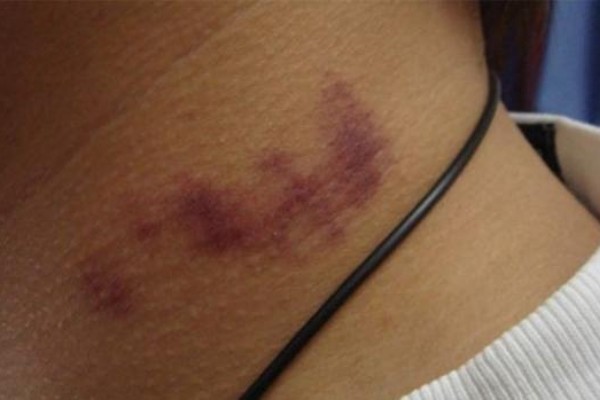 ¡Cuidado! Los “chupetones” sí matan
