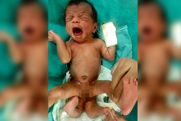 Bebé que nació con cuatro piernas en la India es operado con éxito