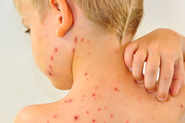 EU sufre el peor brote de sarampión en los últimos 25 años