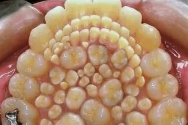 No es broma: extraen más de 500 dientes a niño de siete años