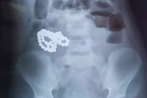 Hospitalizan a niño por dolor de estómago; le extraen 61 bolas magnéticas