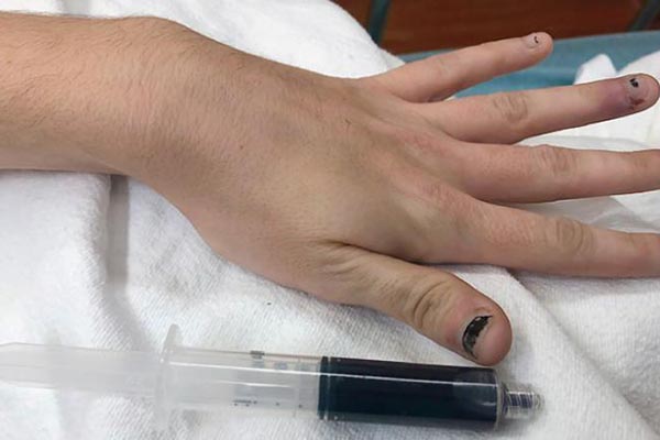 Se volvió de sangre azul... por tomar pastillas para el dolor