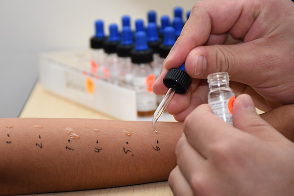 Prueba epicutánea modificada, útil para la detección de alergias: investigadores del HUP