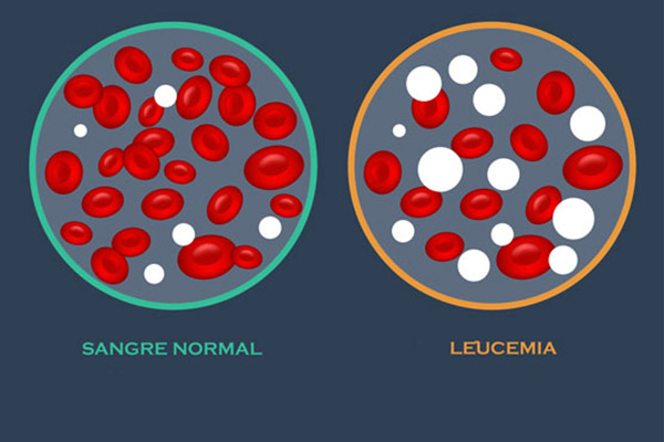 Leucemia, el cáncer indolente, qué es y cómo detectarlo