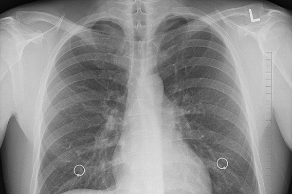 Cáncer de pulmón afecta al 71% de la población mundial