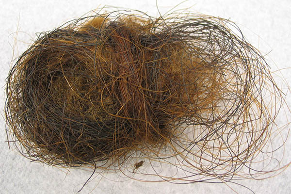 Extraen 3 kilogramos de cabello… ¡del estómago de una joven!
