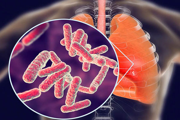 Día mundial de la tuberculosis: ¿por qué seguimos sin curar la infección más mortal del mundo?