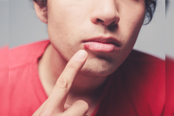 Un simple herpes podría llevar a enfermedades fatales