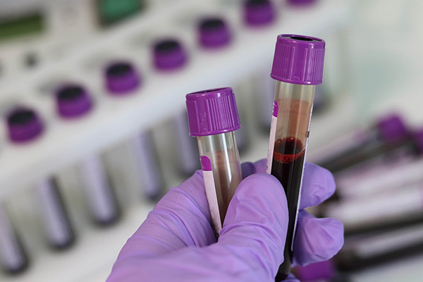 Estudio en EU detecta anticuerpos COVID-19 en sangre donada en diciembre 2019
