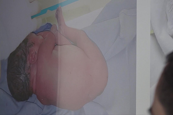 Avance médico salva vidas en México gracias a la cirugía fetal