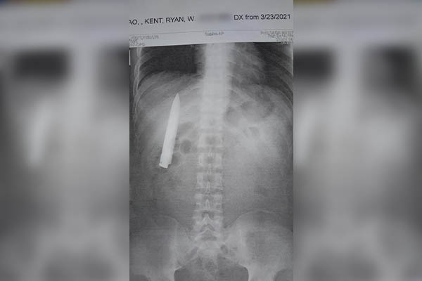 Un hombre vive con un cuchillo clavado en su pecho durante un año