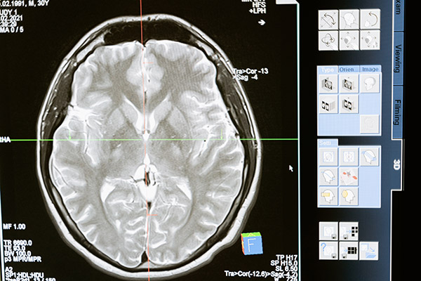 Uso de interfaz cerebro-máquina en la rehabilitación de derrames cerebrales