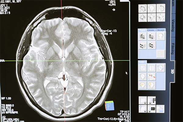 Hallan hierro y cobre en cerebros de pacientes fallecidos con Alzheimer