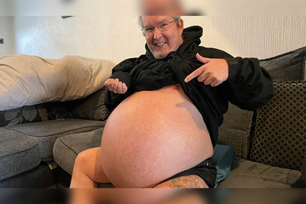 Hombre es asfixiado por sus riñones que crecen de forma desmedida y sin parar