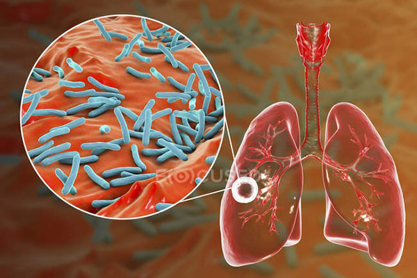 Aumentó mortalidad por tuberculosis en medio del covid-19, dice la OMS