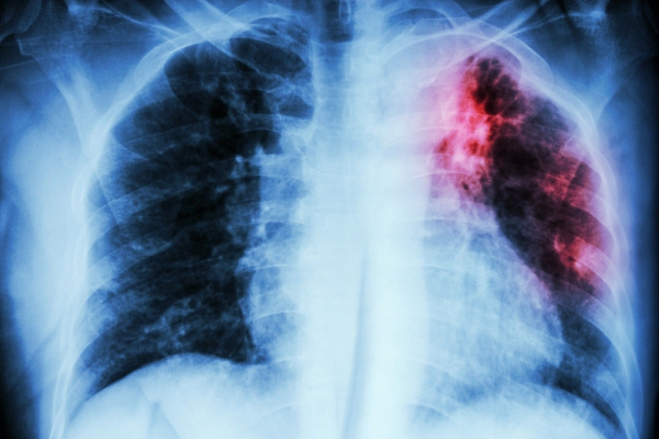 Una variación genética resta eficacia a medicamentos contra la tuberculosis