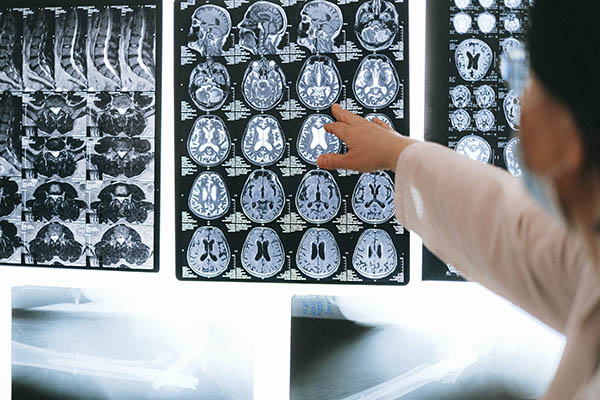 Luego de 20 años probarán por primera vez la vacuna nasal contar el alzhéimer