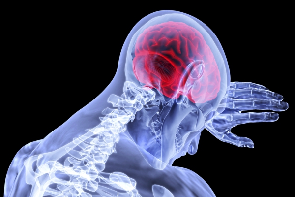 Cómo detectar un derrame cerebral antes de sufrirlo
