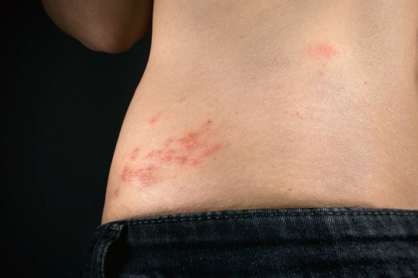 Vacunas anticovid podrían reactivar el herpes zóster, revela estudio