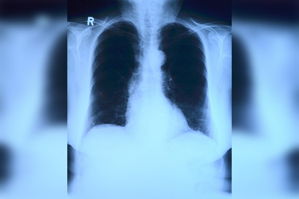 Covid de larga duración genera daño pulmonar indetectable por pruebas convencionales