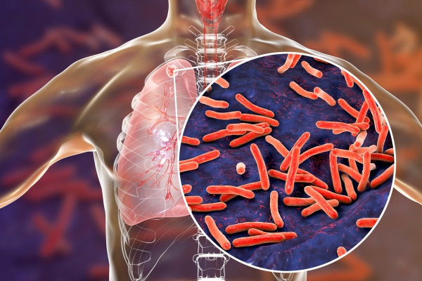 La tuberculosis, enfermedad peligrosa que causa 1.4 millones de muertes