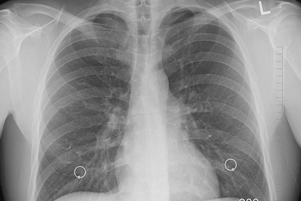 Aire contaminado, factor para desarrollar cáncer pulmonar
