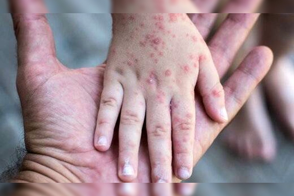 Agencias de la ONU advierten de serios brotes de sarampión en niños