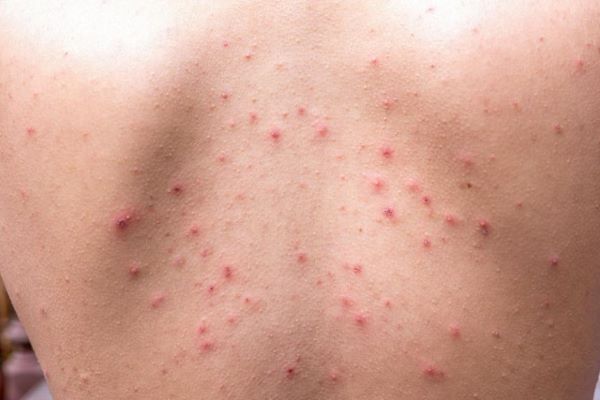 Suecia clasifica viruela del mono como enfermedad peligrosa para la sociedad