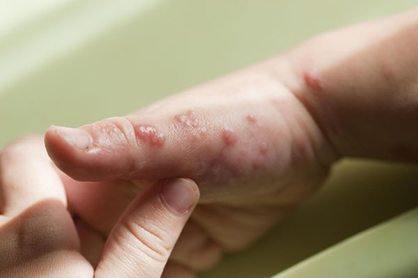Emite Salud protocolo para posibles casos de viruela del mono en México