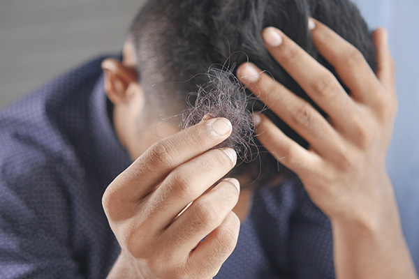 Aprueban en EU la primera píldora para el tratamiento de la alopecia severa