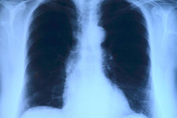 Cambio climático, impacto directo en enfermedad pulmonar