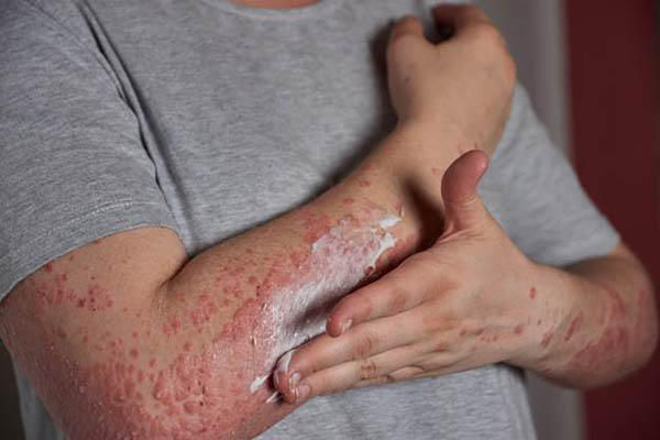 Psoriasis provoca segregación y rechazo en entornos sociales, personales y laborales