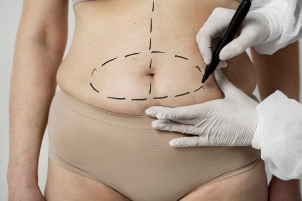 ¿Vale la pena? Costos y riesgos de la liposucción