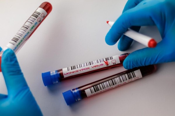 Brote mundial de viruela del mono persiste; aumentan los casos en 26 %