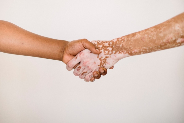 ¿Qué es la lepra y por qué se discrimina tanto?
