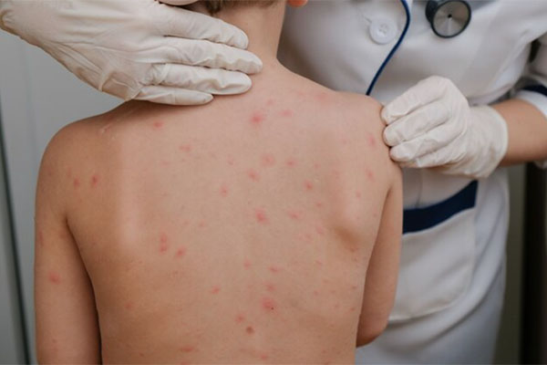 Registran 118 contagios de sarampión en Inglaterra en una semana