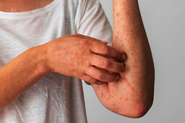 Rumanía declara el fin de la epidemia de sarampión en el país