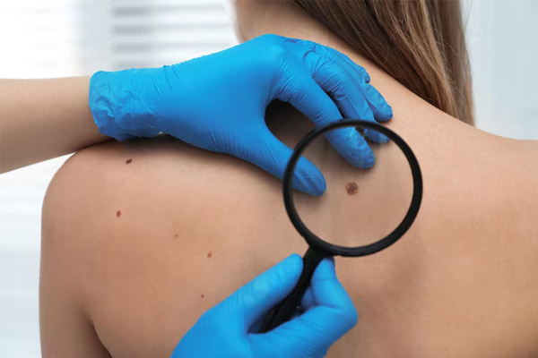 ¿Lunar o señal de alerta? Lo que debes saber sobre el melanoma