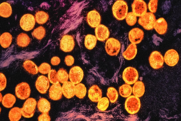 Viruela negra, la enfermedad que mató a millones y puso en la mira a la gripe aviar