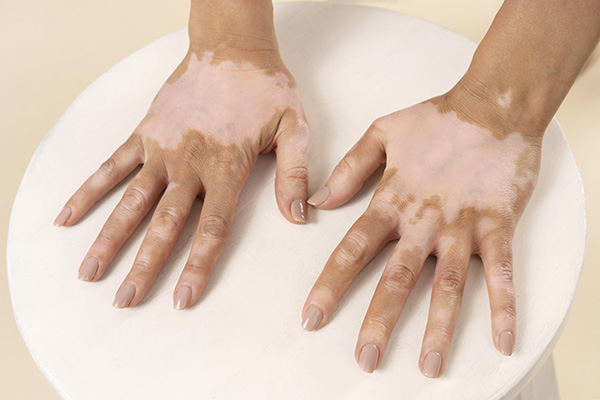 Vitiligo y desigualdad: el costo de sanar sigue fuera del alcance de muchos