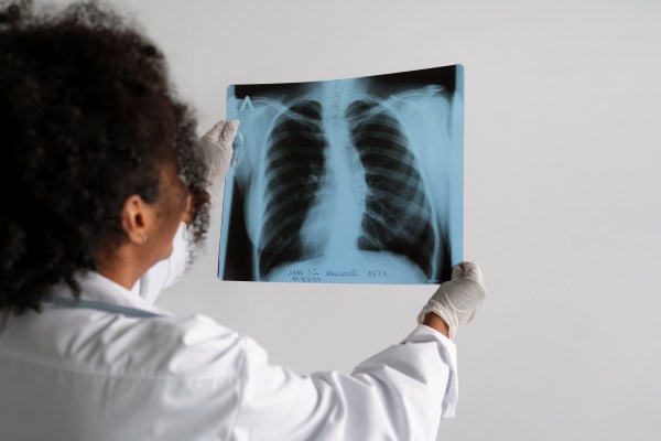 Menos fumadores, más cáncer de pulmón, ¿por qué sucede?