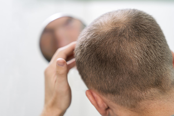 Futbolista da positivo a doping por usar tratamiento contra la alopecia