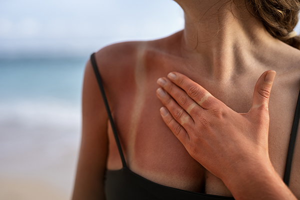 La piel no olvida: quemaduras solares en la niñez aumentan riesgo de cáncer