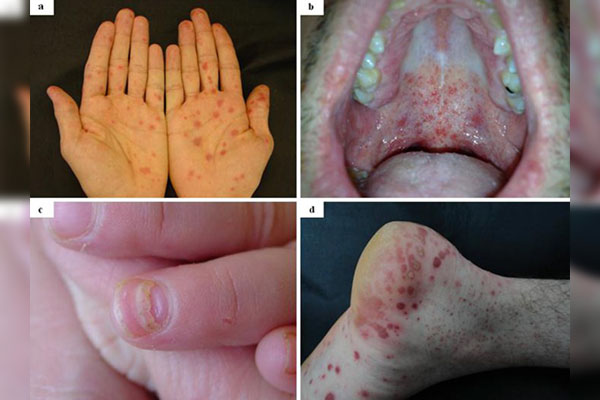 Brote de virus Coxsackie es de cuidado pero no de alarma, ¿por qué?