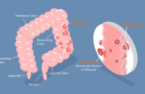 Detectan vínculo entre dieta baja en fibra y diverticulitis